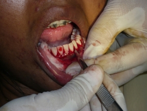 gingival treatments and surgeries