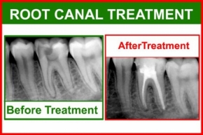 Endodontics (Root Canal Treatment)