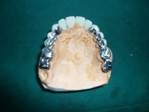 Crown and Bridges & Veneers